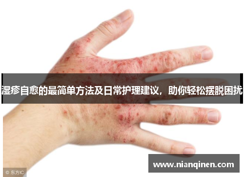 湿疹自愈的最简单方法及日常护理建议,助你轻松摆脱困扰 湿疹自愈的最简单方法及日常护理建议,助你轻松摆脱困扰